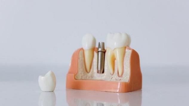 Zubni implanti – sve što niste niste znali o njima