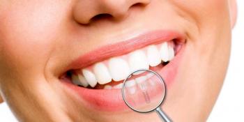5 savjeta za bolje održavanje zubnih implantata
