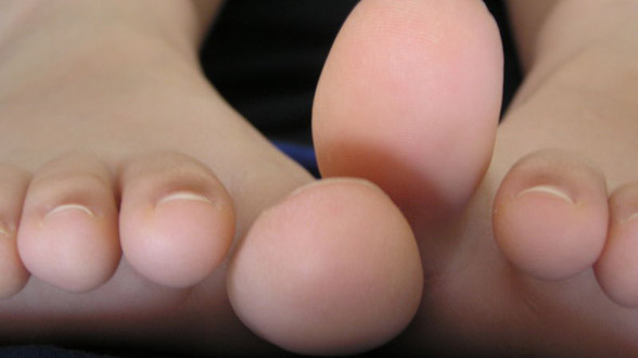 Atletsko stopalo – česta gljivična infekcija