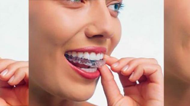 Sve što treba da znate o folijama za ispravljanje zuba