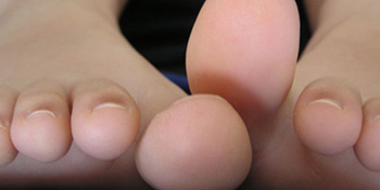 Atletsko stopalo – česta gljivična infekcija