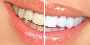 Kako izbijeliti zube za samo 5 minuta