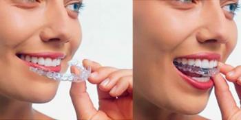 Sve što treba da znate o folijama za ispravljanje zuba