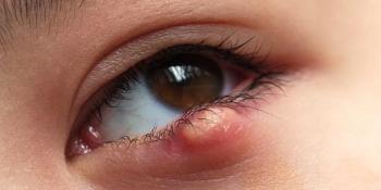 Zbog čega nastaje čmičak na oku i da li je opasan?