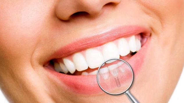 5 savjeta za bolje održavanje zubnih implantata